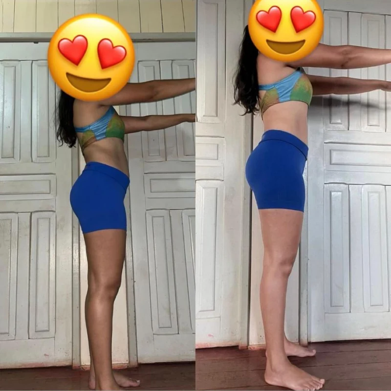 Foto antes e depois real, caso 1